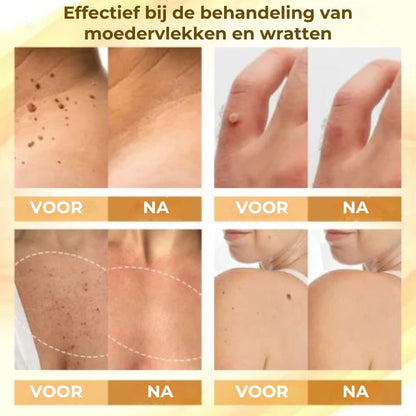 Geconcentreerde herstellende wrattenspray met bijengif