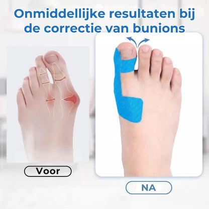 Bunion Correctietape - 20 Stuks