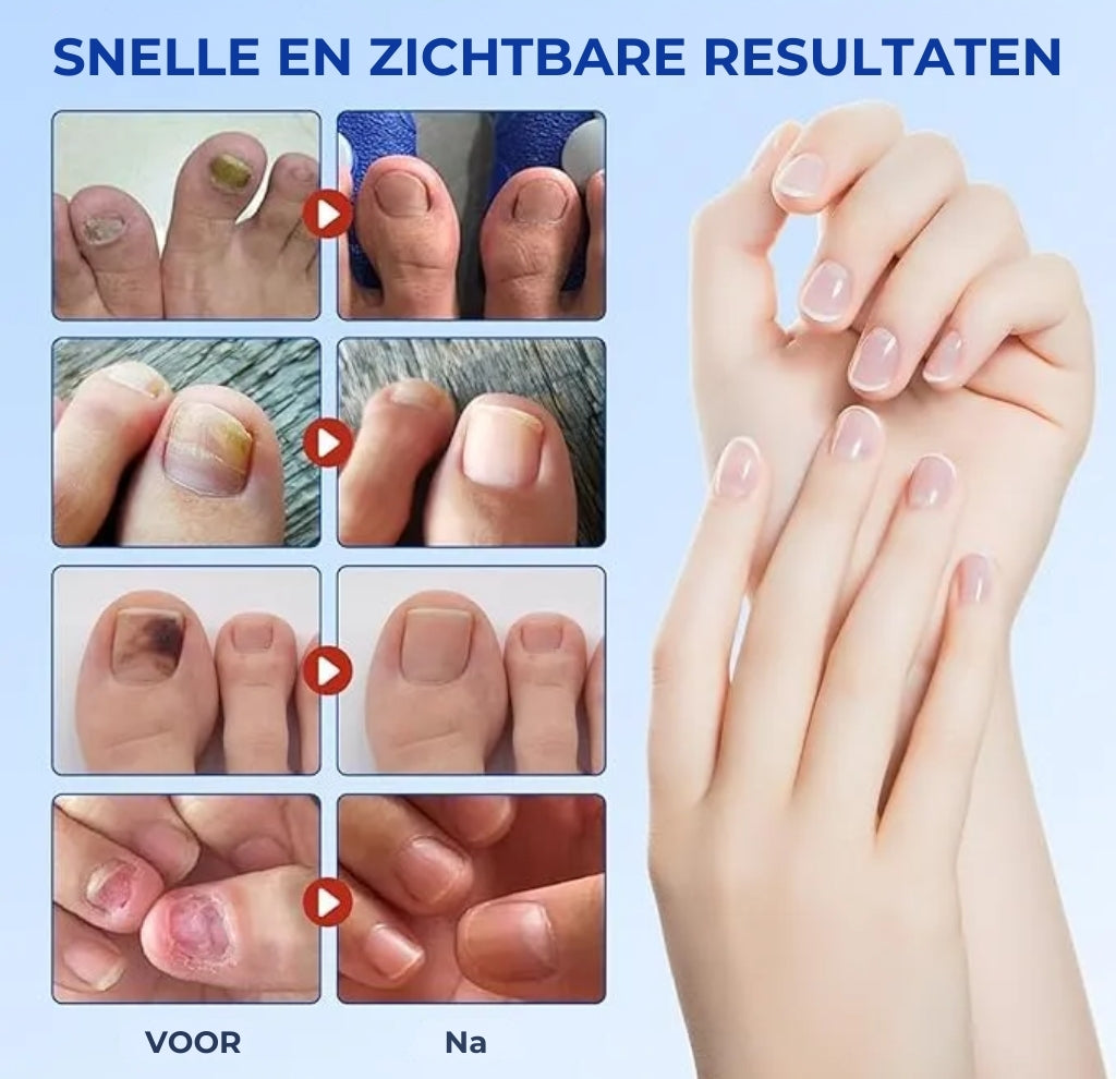 Schimmelnagel Behandelingspleisters – Snelwerkende behandeling voor gezonde nagels