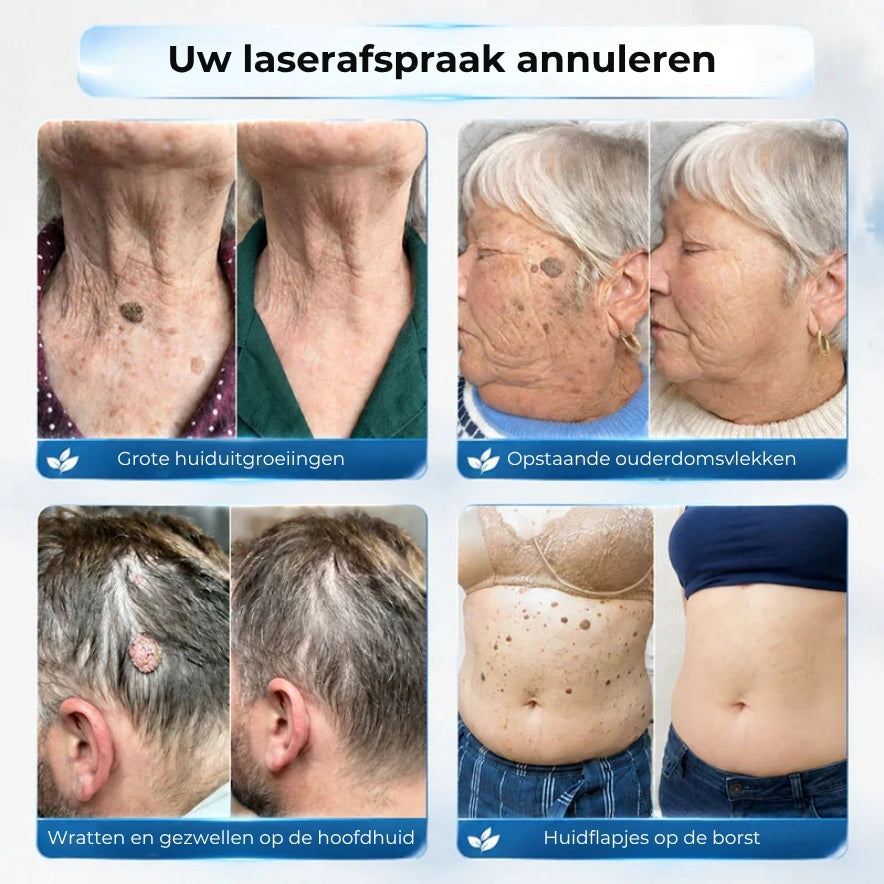 Geavanceerde Roller voor het verwijderen van Huidtags en Wratten
