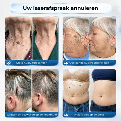 Geavanceerde Roller voor het verwijderen van Huidtags en Wratten