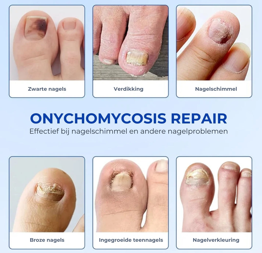 Schimmelnagel Behandelingspleisters – Snelwerkende behandeling voor gezonde nagels