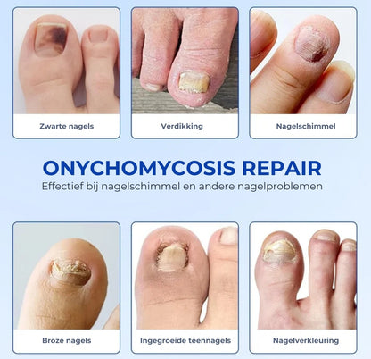 Schimmelnagel Behandelingspleisters – Snelwerkende behandeling voor gezonde nagels
