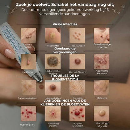 Geavanceerde Roller voor het verwijderen van Huidtags en Wratten