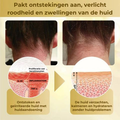 Geconcentreerde herstellende wrattenspray met bijengif